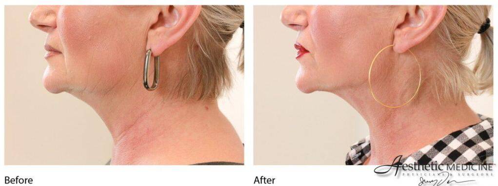 Lipolift Neck/Chin 3 