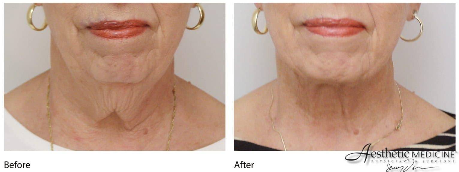 Lipolift Neck/Chin 4 