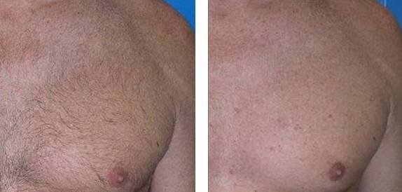 Hair Removal 