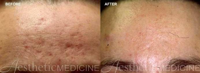 Acne Treatments 