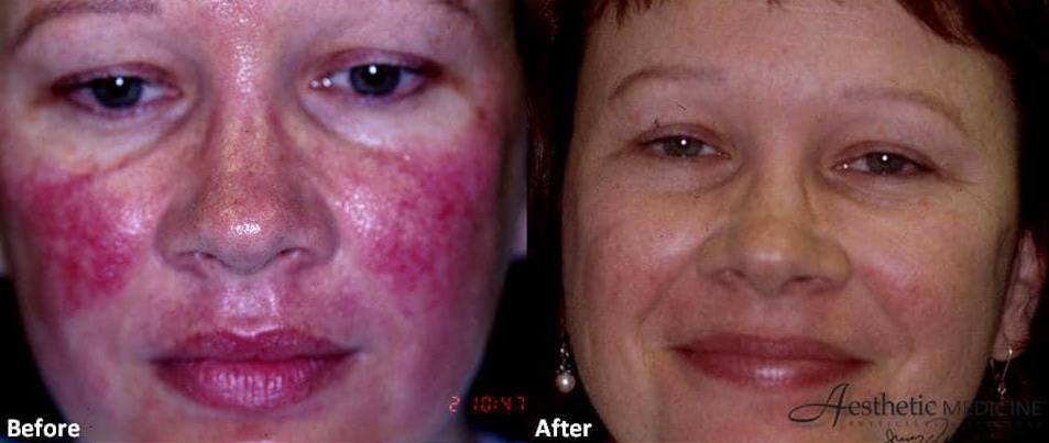 Rosacea Treatments 