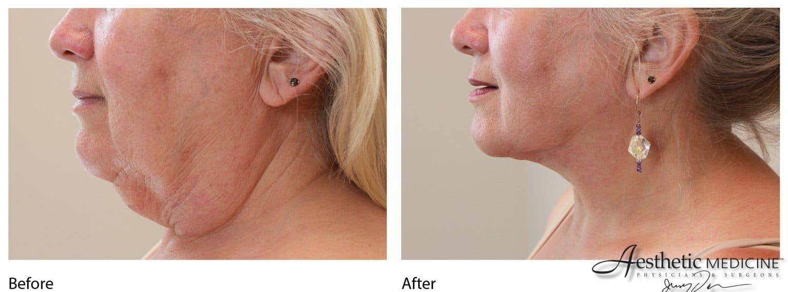Lipolift Neck/Chin 1 