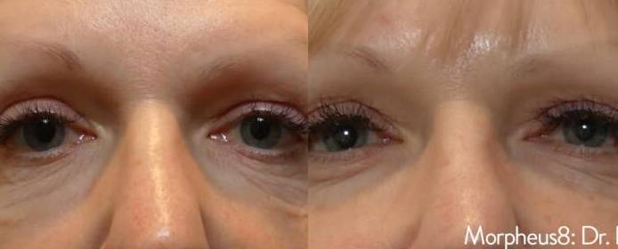 Microneedling 