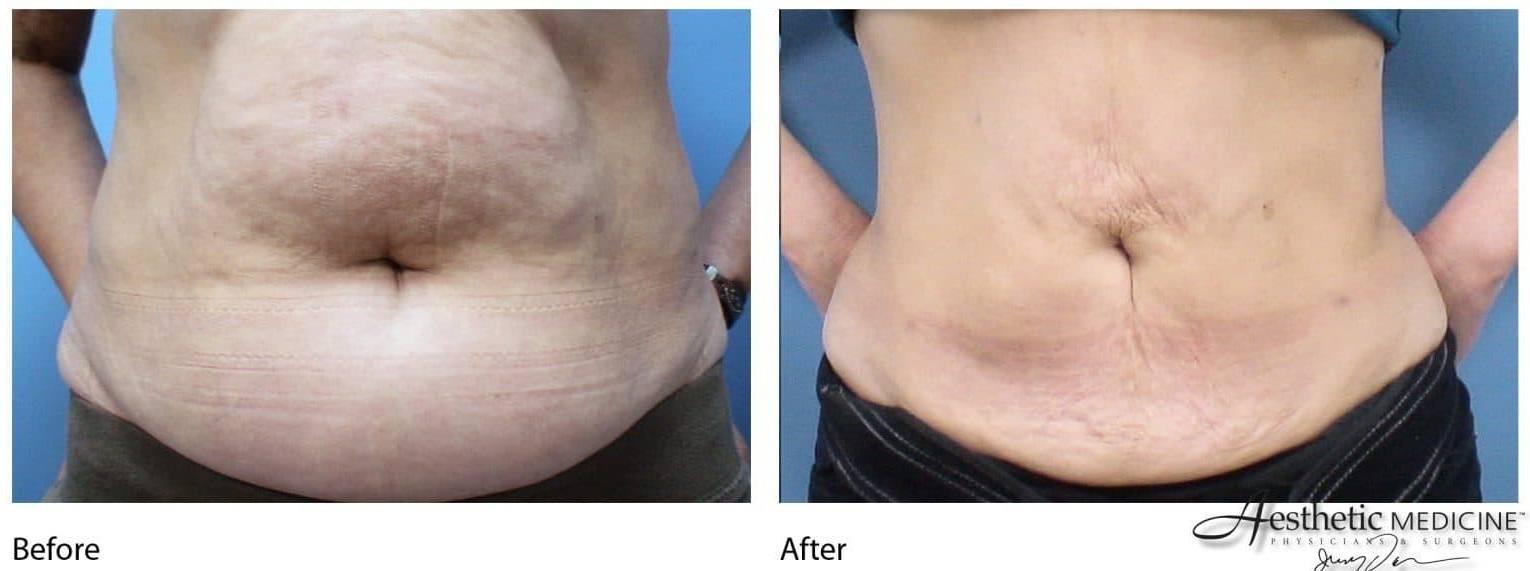 Lipolift Abs 1 