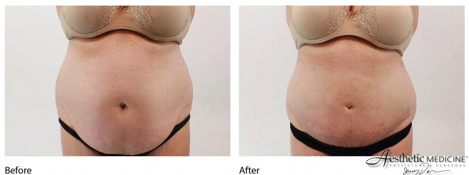 Lipolift Abs 2 