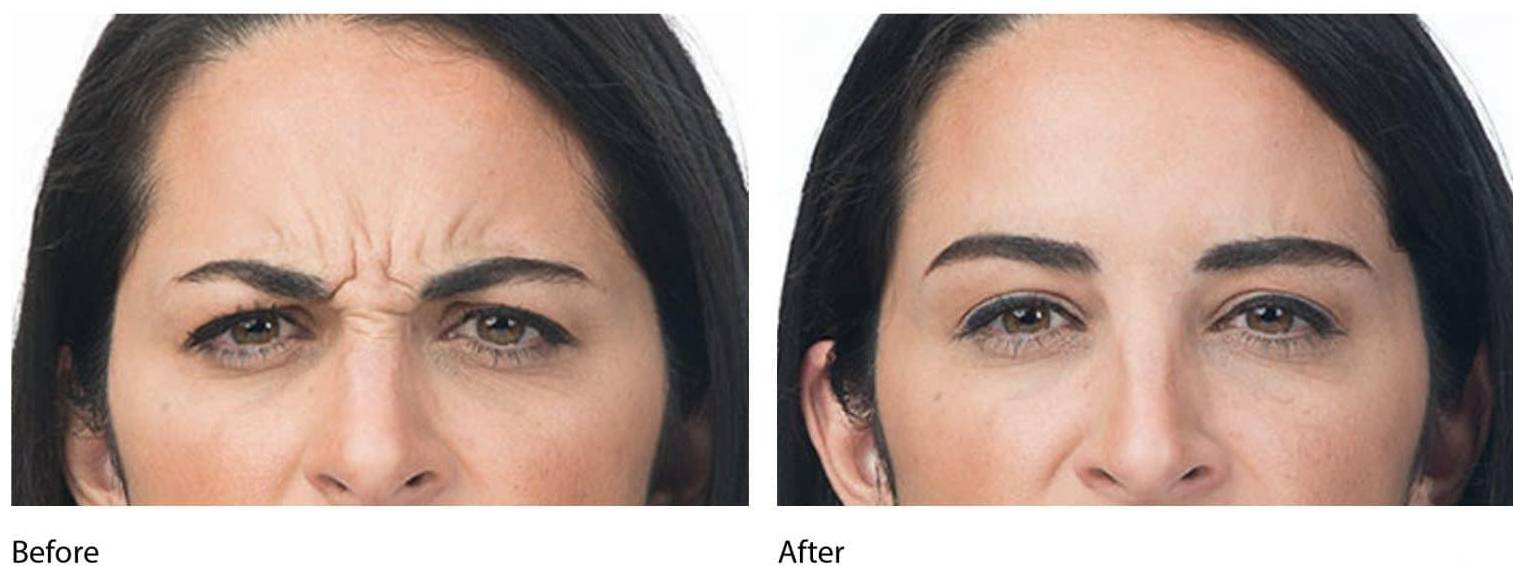 Botox / Dysport 