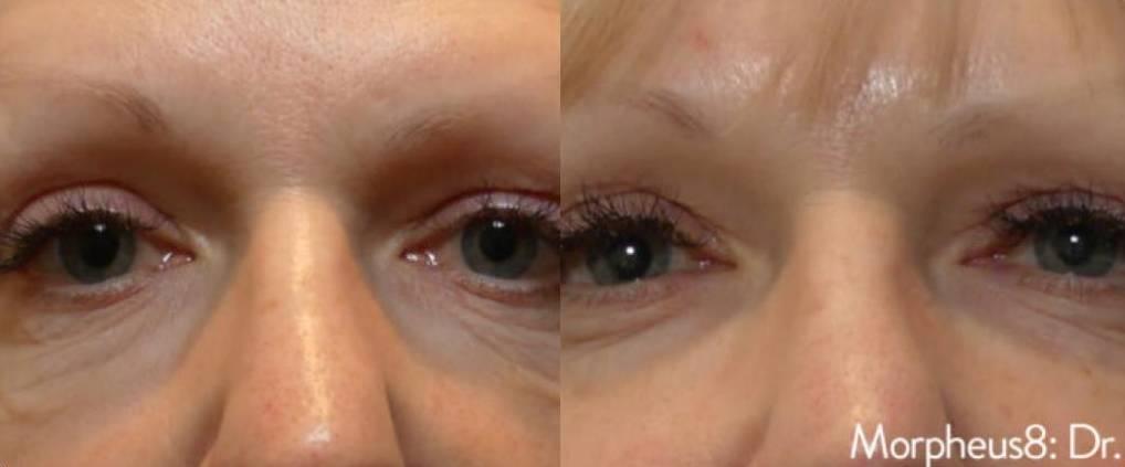 Mini Facelift Eyes 