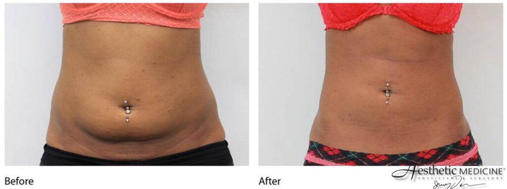Lipolift Abs 3 