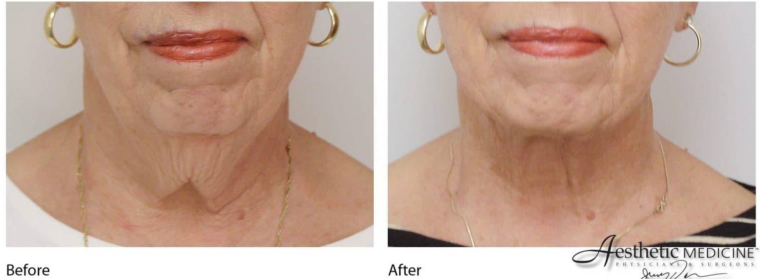 Mini Facelift Neck 