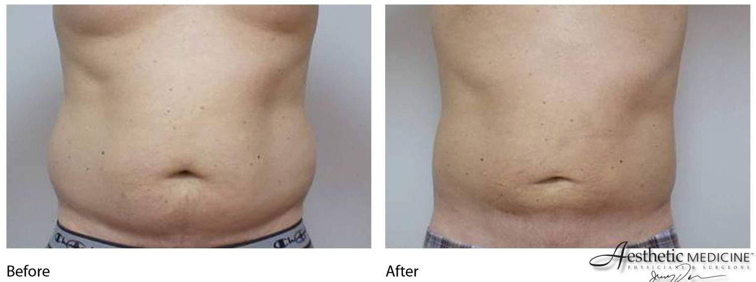 Lipolift Flanks 