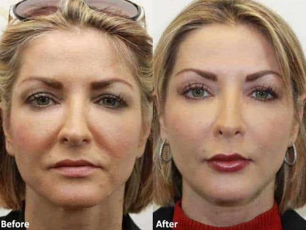 Facial Fat Grafting 