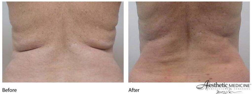 Lipolift Bra Bulge 