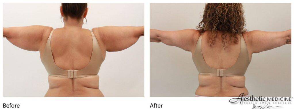 Lipolift Arms 