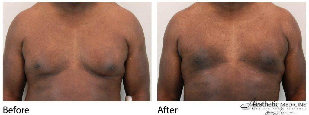 Lipolift Pecs 
