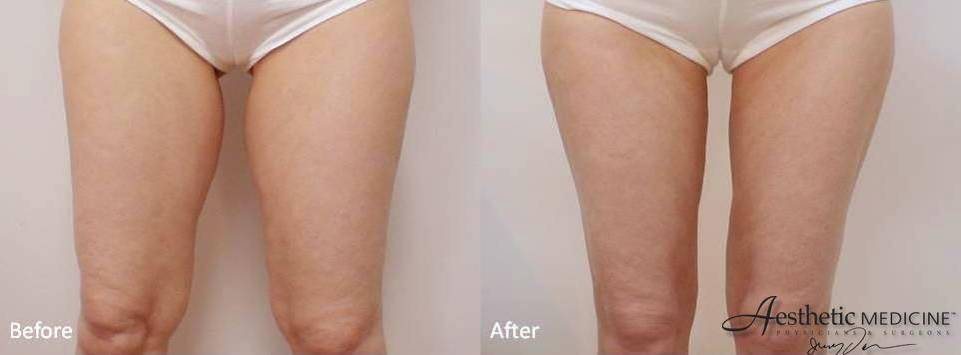 Lipolift Thighs And Knees 