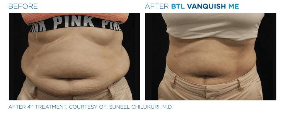 Vanquish Abs 1 