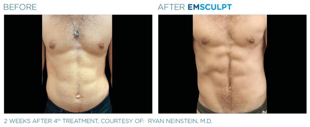 Emsculpt Abs 