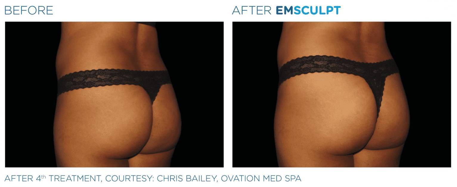 Emsculpt Buttocks 