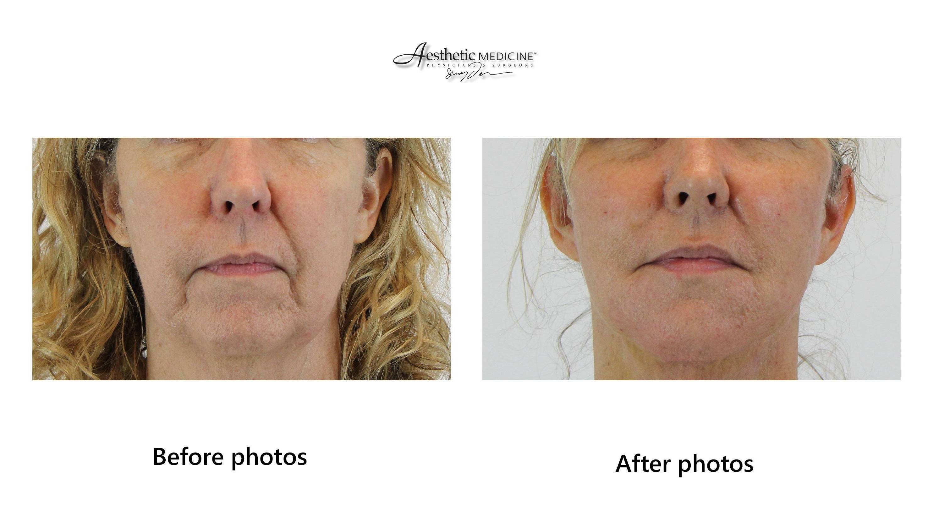 Facial Fat Grafting 2 