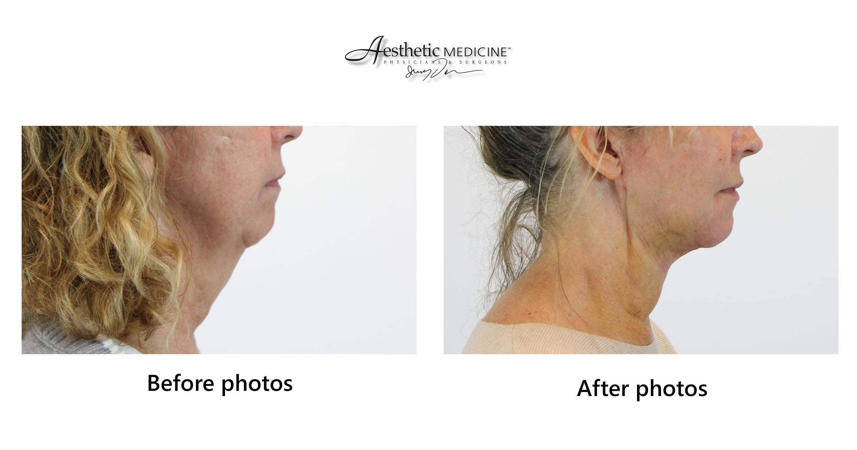 Mini FaceLift Neck 2 