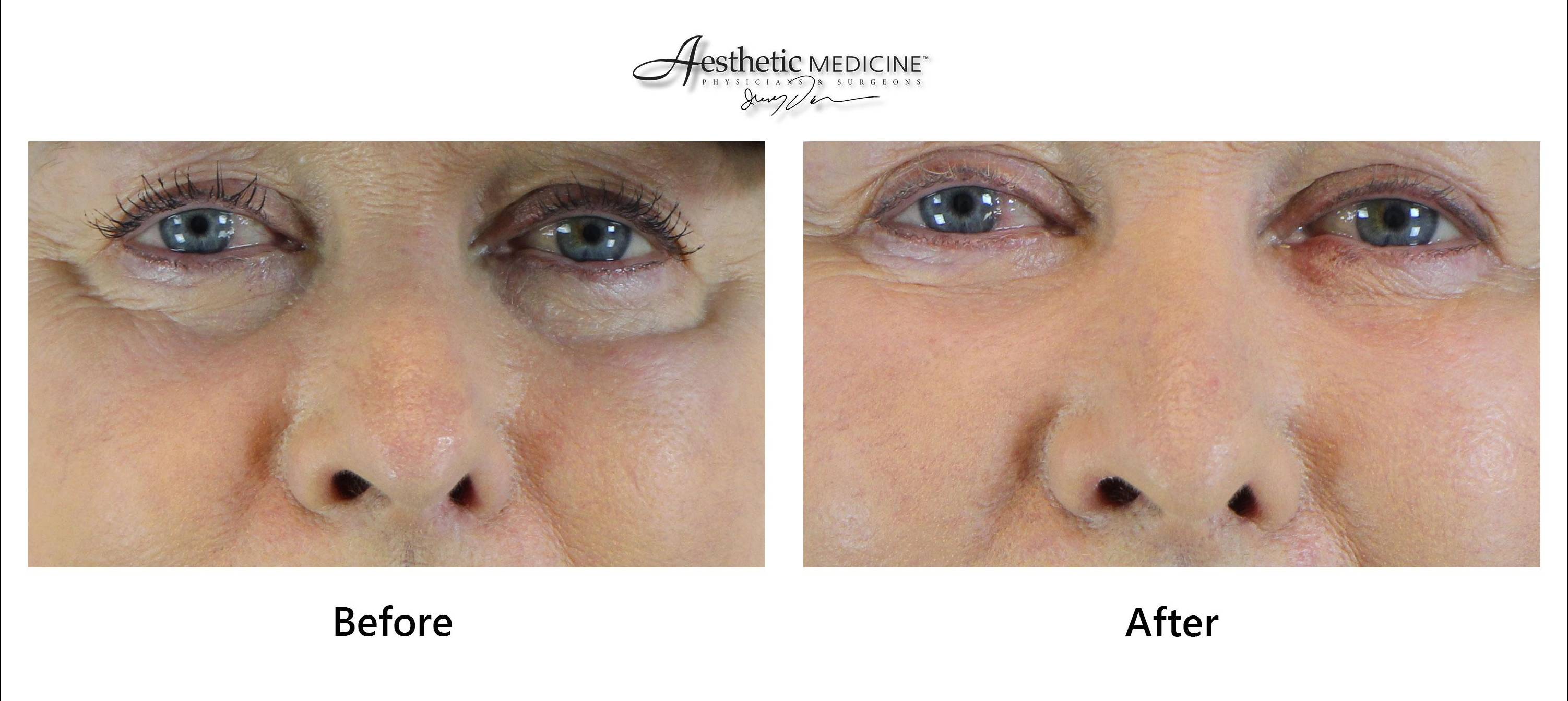 Facial Fat Grafting 3 
