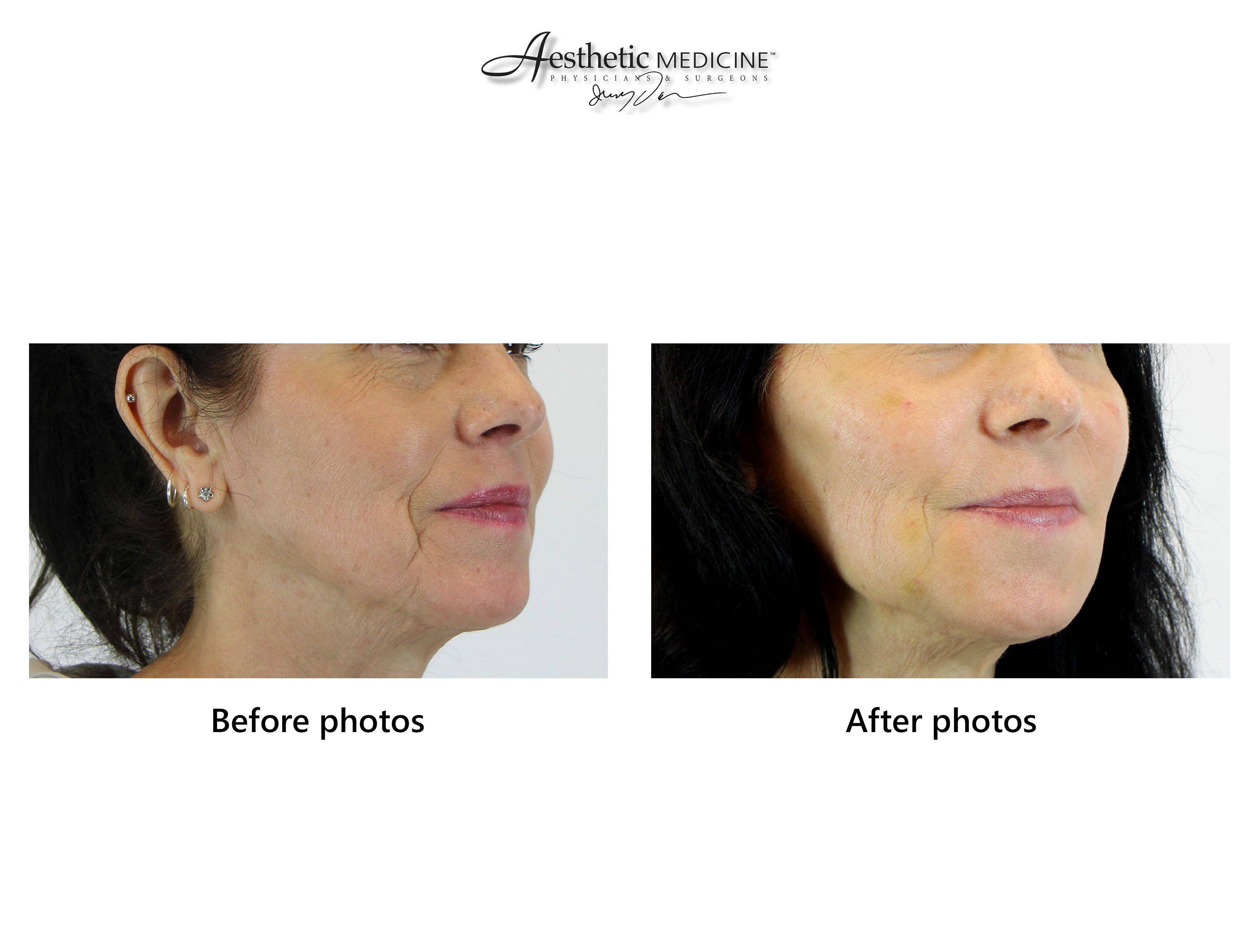 Facial Fat Grafting 4 