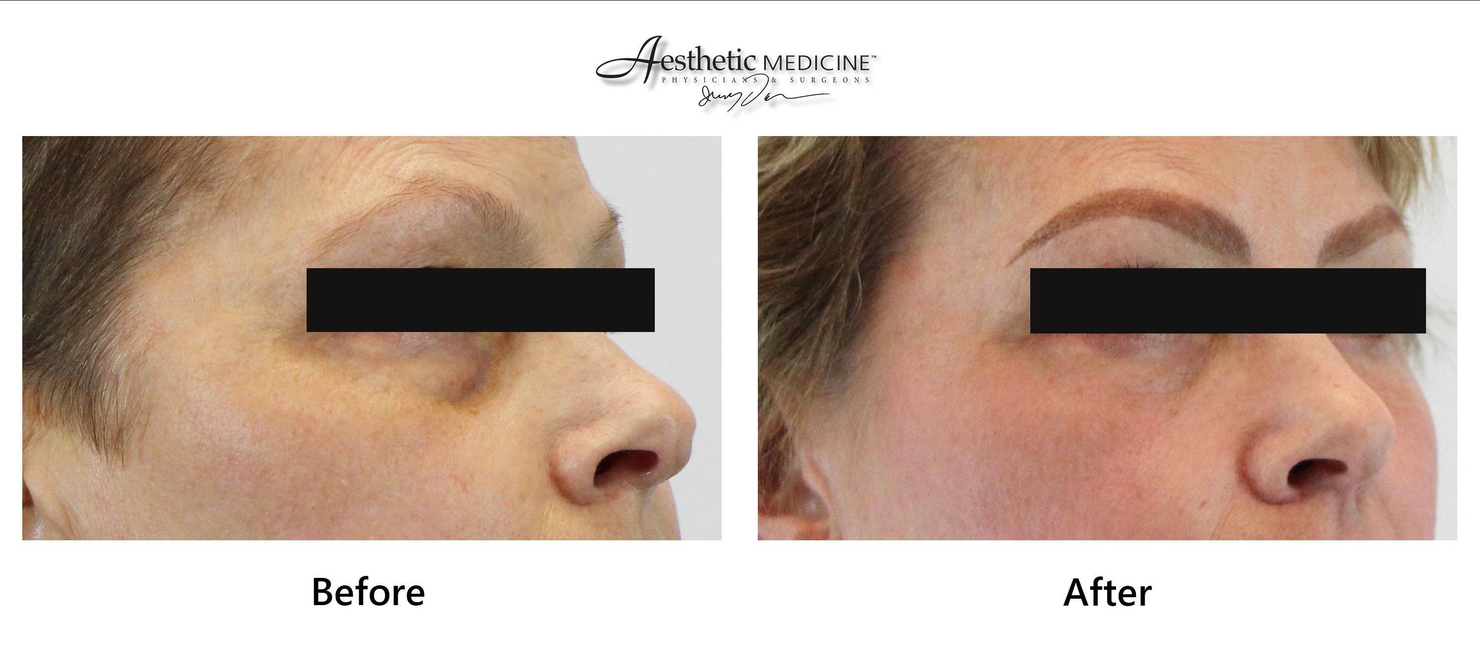 Facial Fat Grafting + Under-eyes 