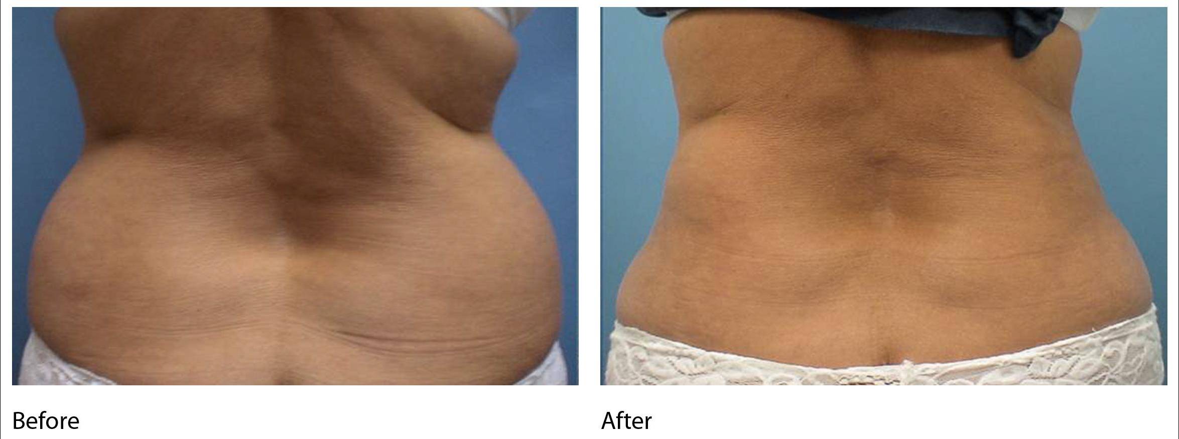Lipo Lift Flanks 