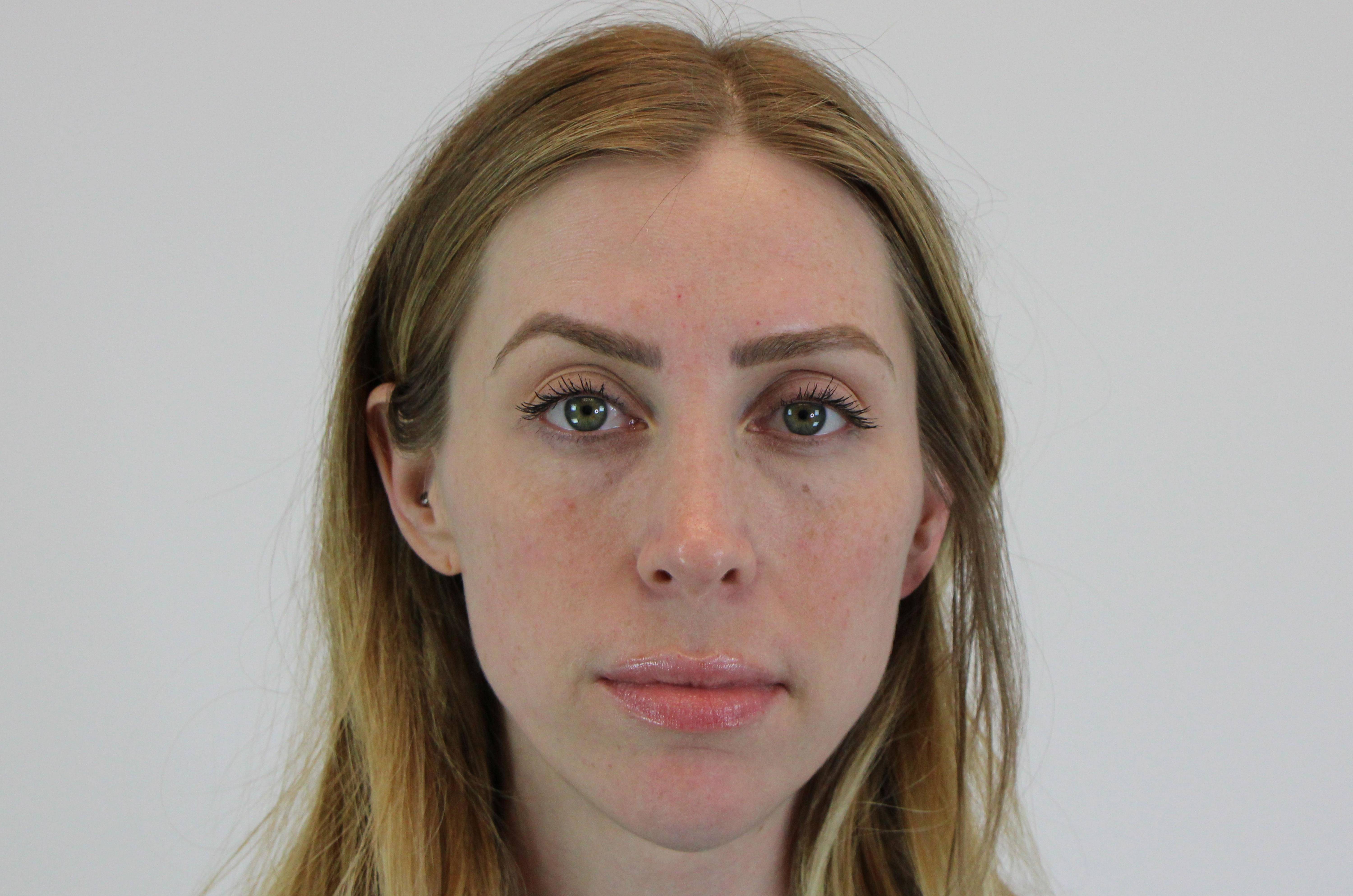 Filler Cheeks Before