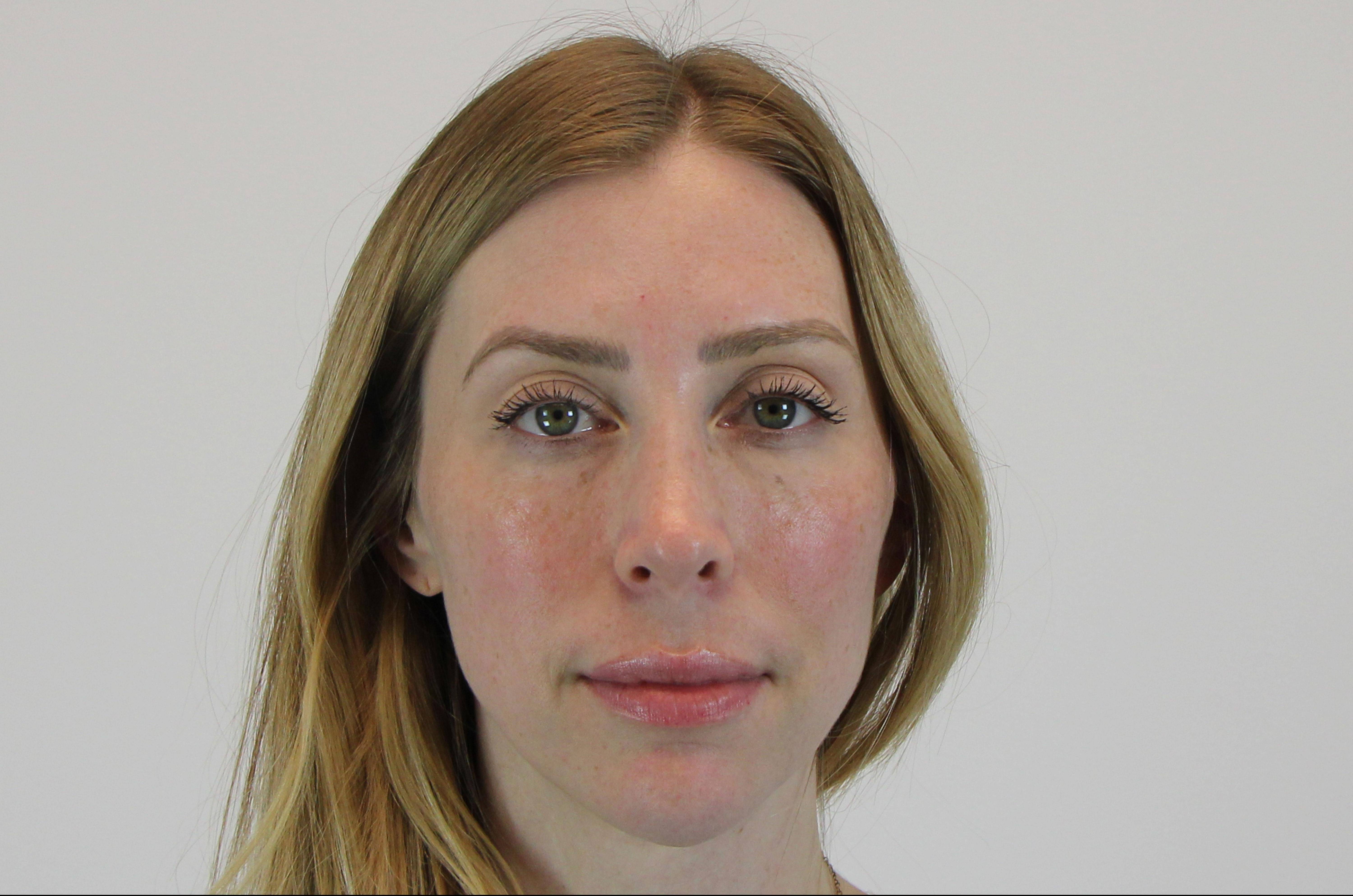 Filler Cheeks After