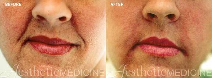Dermal Fillers 