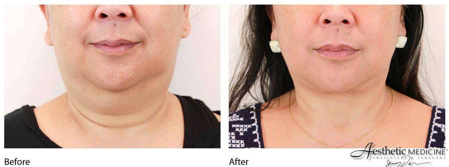 Lipolift Neck/Chin 2 