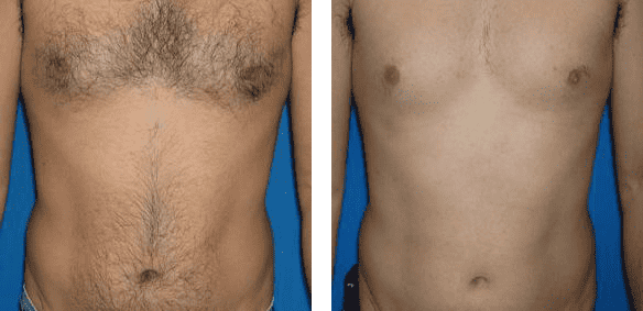 Befor_Hair-Removal3-1