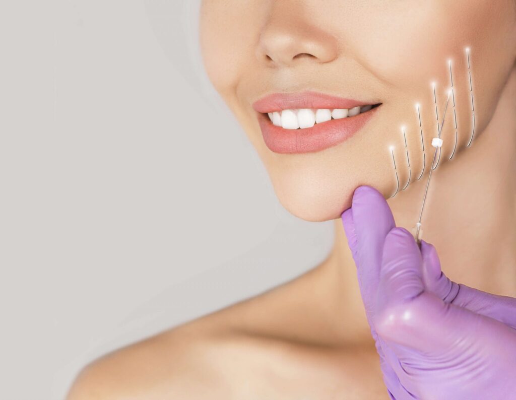 PDO THREAD LIFT  Align Injectable Aesthetics