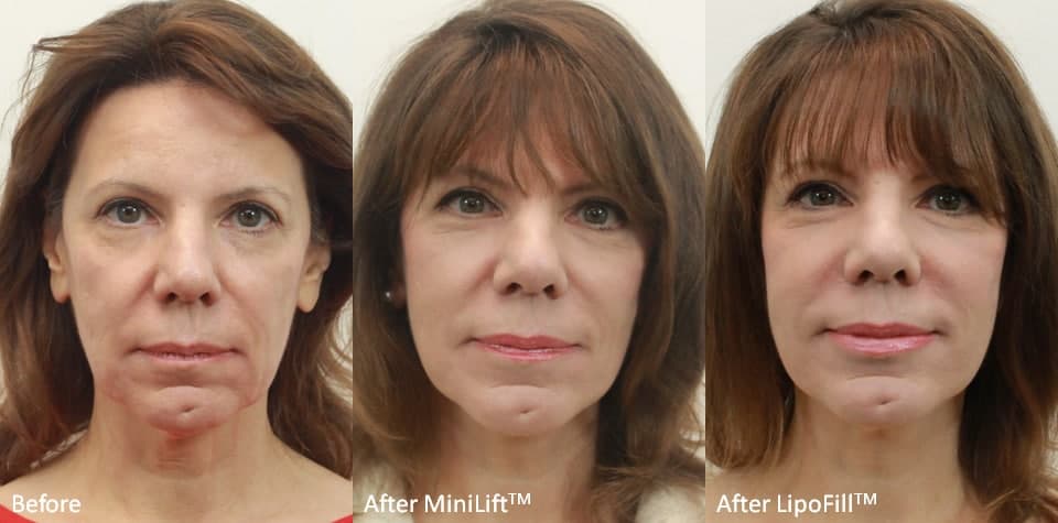 MiniLift-and-LipoFill-1