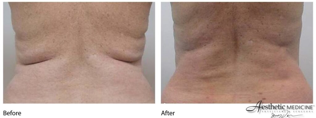 Eves Body Organic MedSpa - Before and After Bra line Lipo