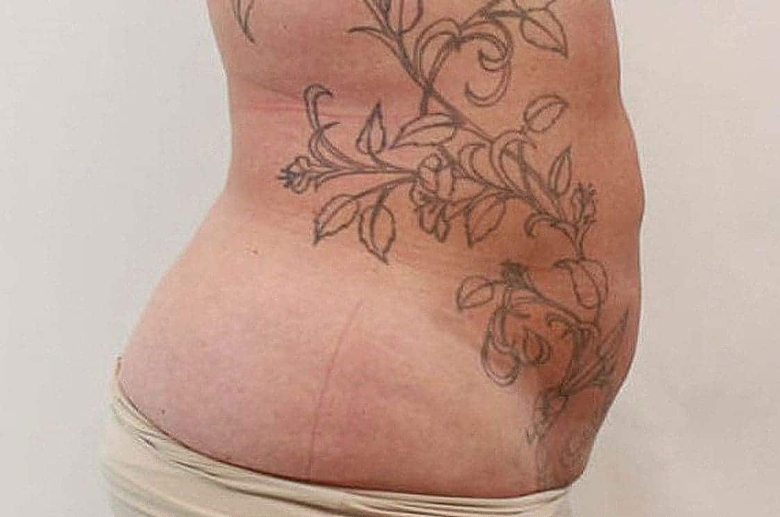 lipolift-abs-large-5-After.jpg