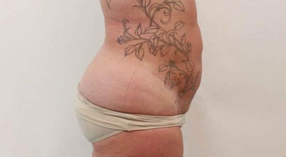 Lipolift Laser Liposuction After